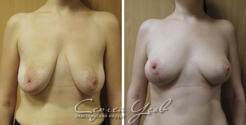 Подтяжка груди без имплантатов - фото